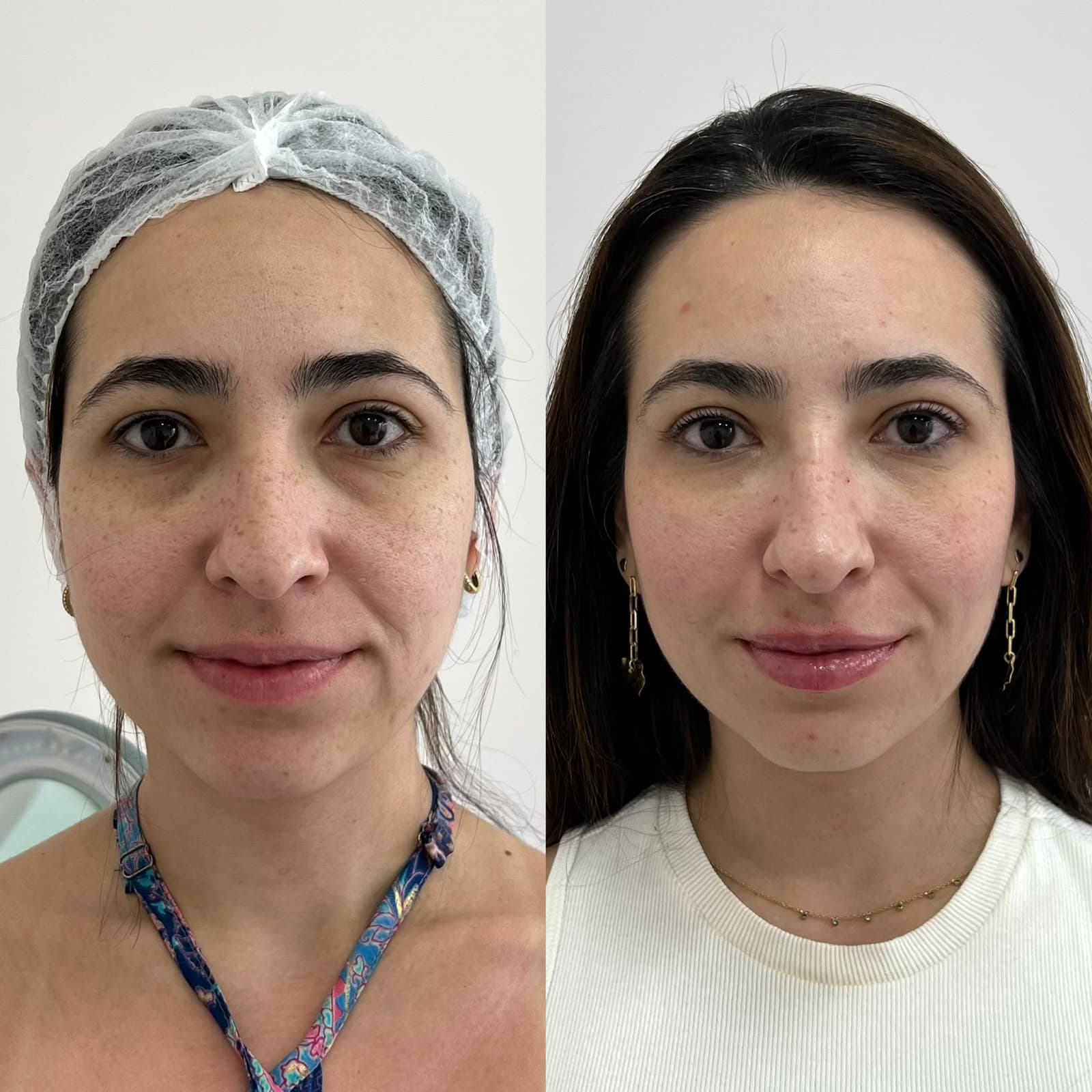 Antes e depois de harmonização facial
