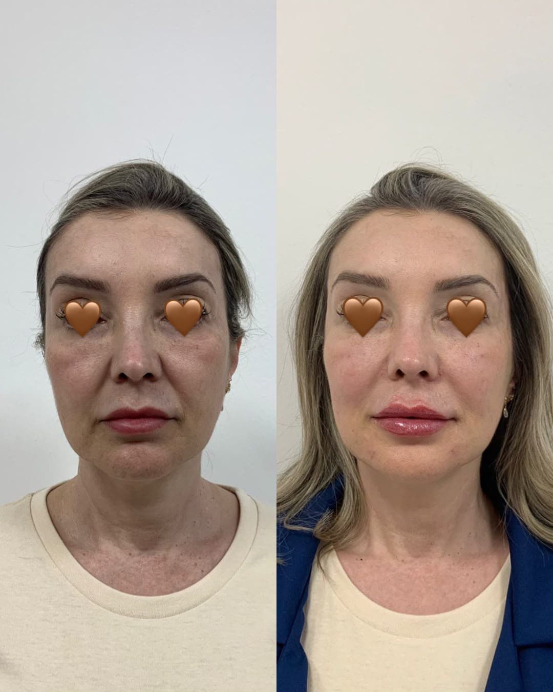 Antes e depois de rejuvenescimento facial