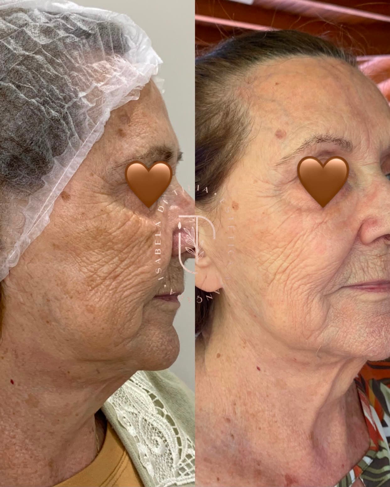 Antes e depois de tratamento de manchas
