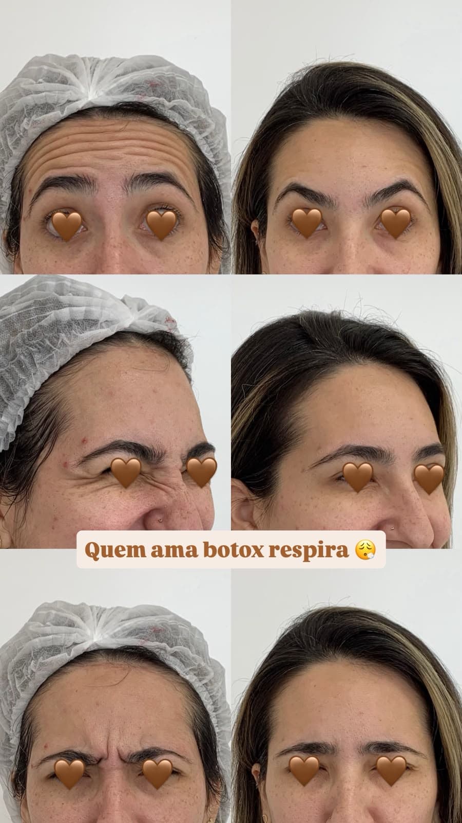 Antes e depois de toxina botulínica